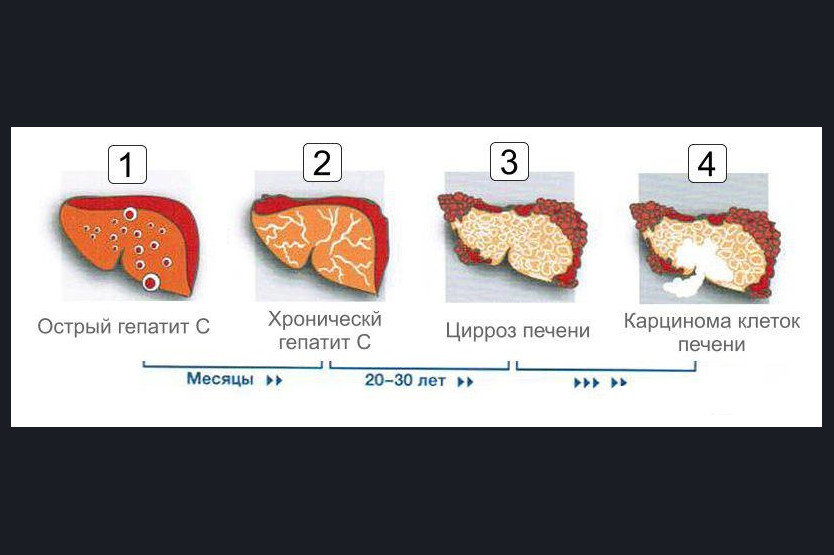 Гепатит Б Фото